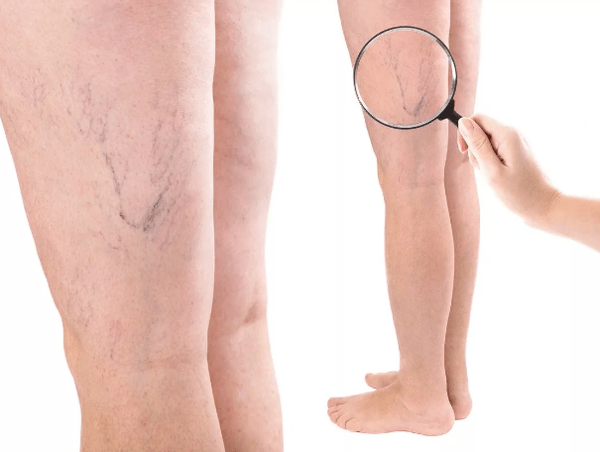 Varices chez les femmes