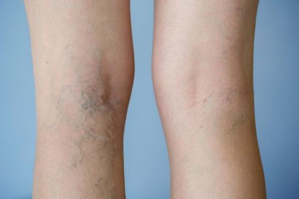 varices