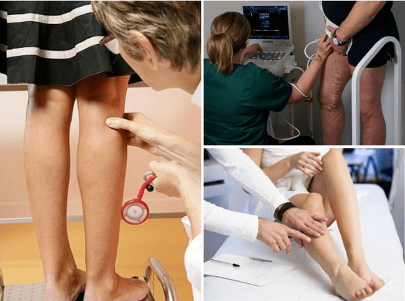 Varices sur les jambes