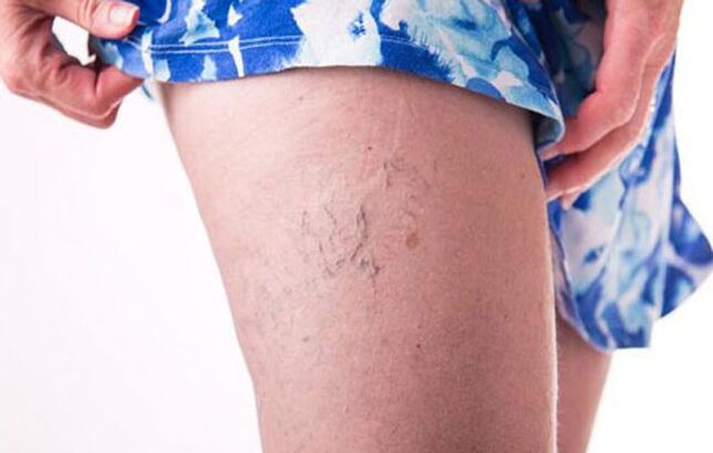 Varices sur la jambe