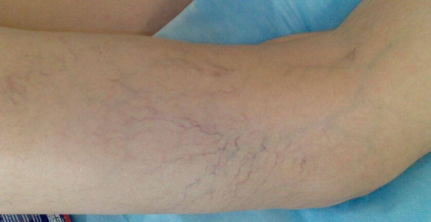 Étoiles vasculaires sur les jambes