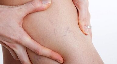 Signes et symptômes de varices