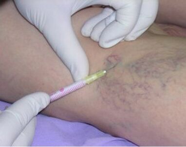 injections pour les varices