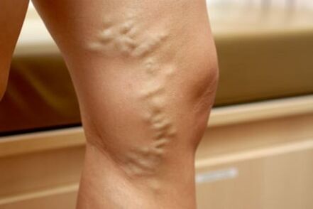médicaments pour les varices