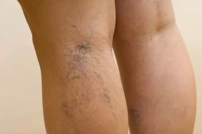Pathologie veineuse des jambes