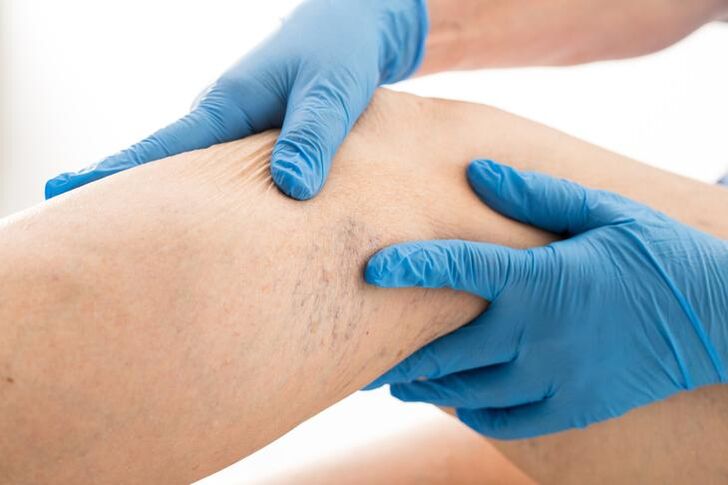 médecin examine les jambes avec des varices