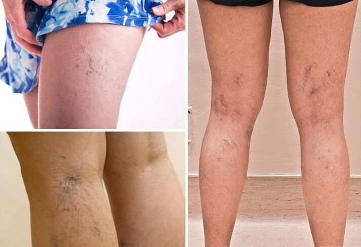 varices dans les jambes