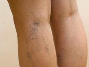 Les veines qui dépassent sous la peau sont un symptôme de varices sur les jambes